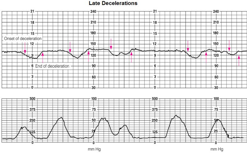<ul><li><p>FHR <span style="color: rgb(233, 97, 97);"><strong>drops after contractions end</strong></span></p><ul><li><p>cause: <span style="color: rgb(212, 46, 46);"><strong>placental insufficiency!! (BAD</strong></span>: baby not getting enough O2)</p></li></ul></li></ul><p></p>