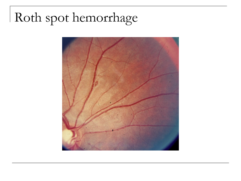 <ul><li><p>Focal accumulations of WBCs or fibrin from retinal vascular blockage</p></li><li><p>Systemic inflammatory conditions, especially bacterial endocarditis</p></li><li><p>Cotton wool spots (localized nerve fiber infarcts)</p></li><li><p>Leukemic cell foci</p></li></ul><p></p>