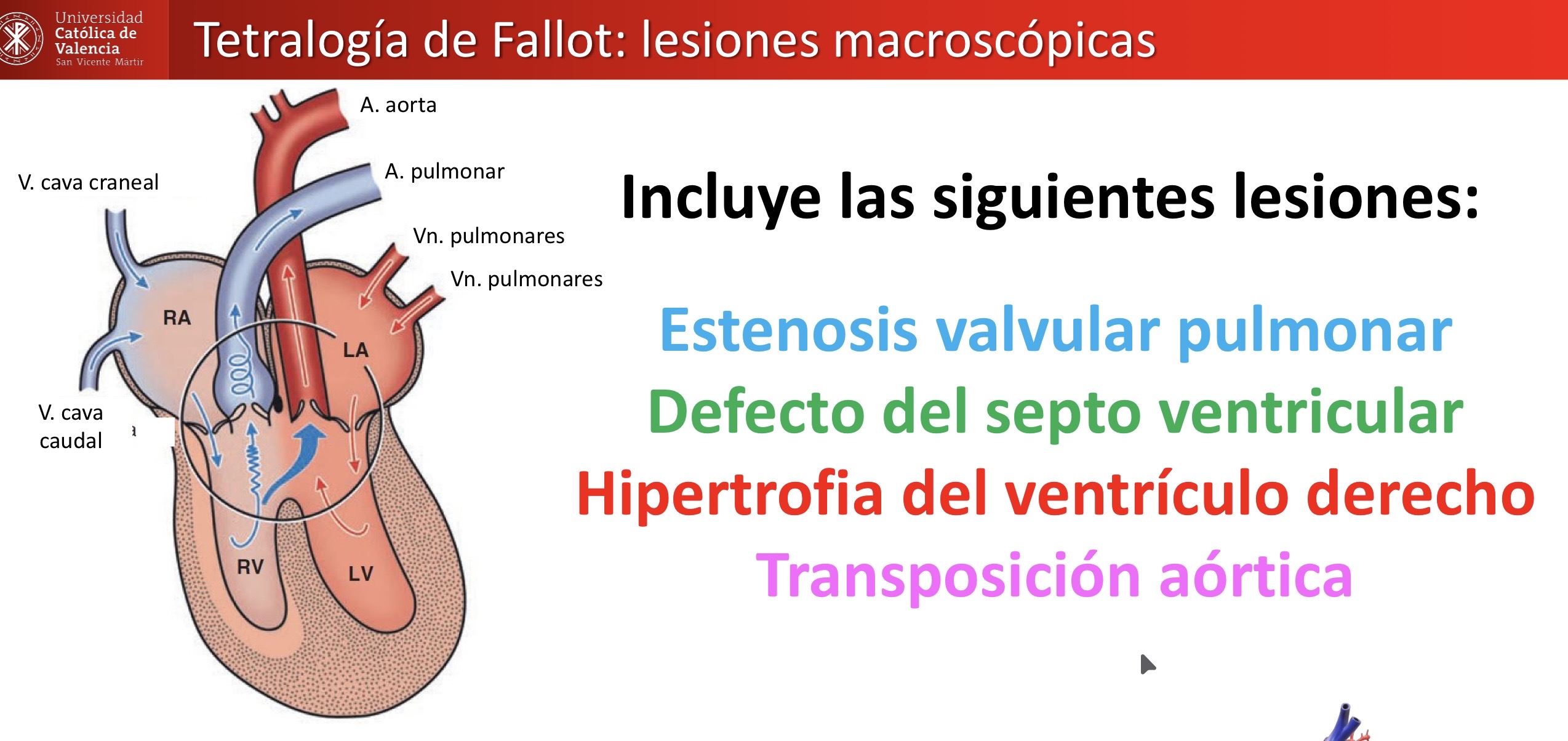 <p>CARDIOVASCULAR: tetralogía de Fallot </p><p></p>