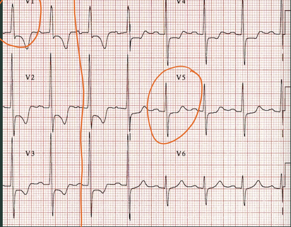 <p>What type of hypertrophy?</p>