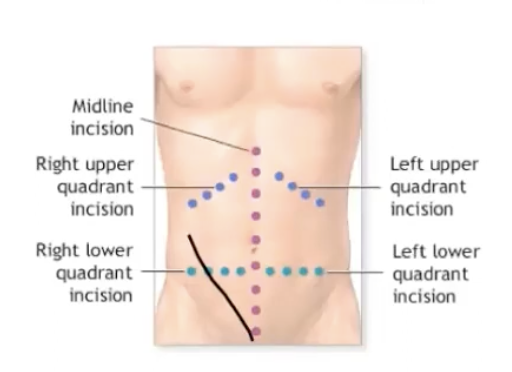<p>Oblique incision in lower right quadrant </p>