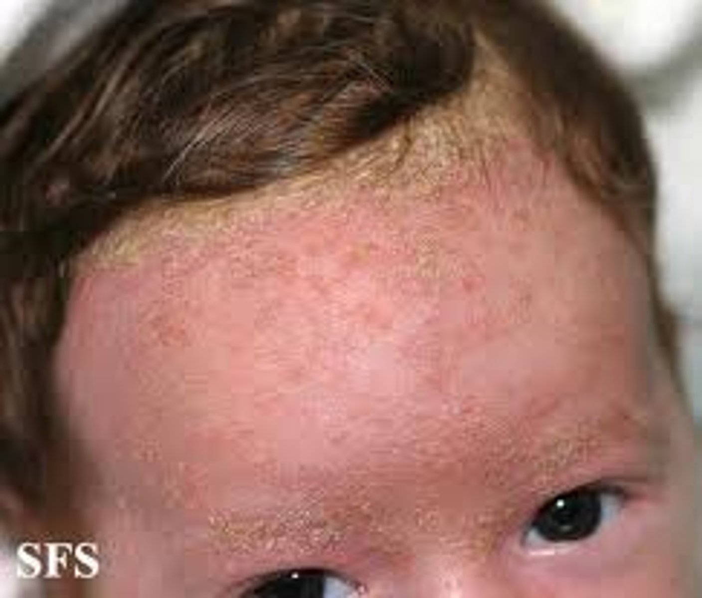 <p>redness and scaling</p><p>-red, scaly, greasy patches of skin</p><p>-forehead and central face</p><p>-improve with moisturizer and mild topical steroids</p>