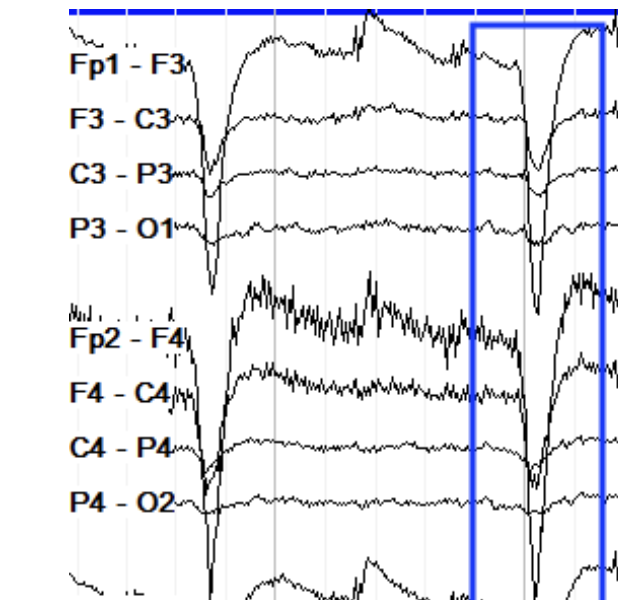 <p>No posterior fields, positive anterior activity</p>