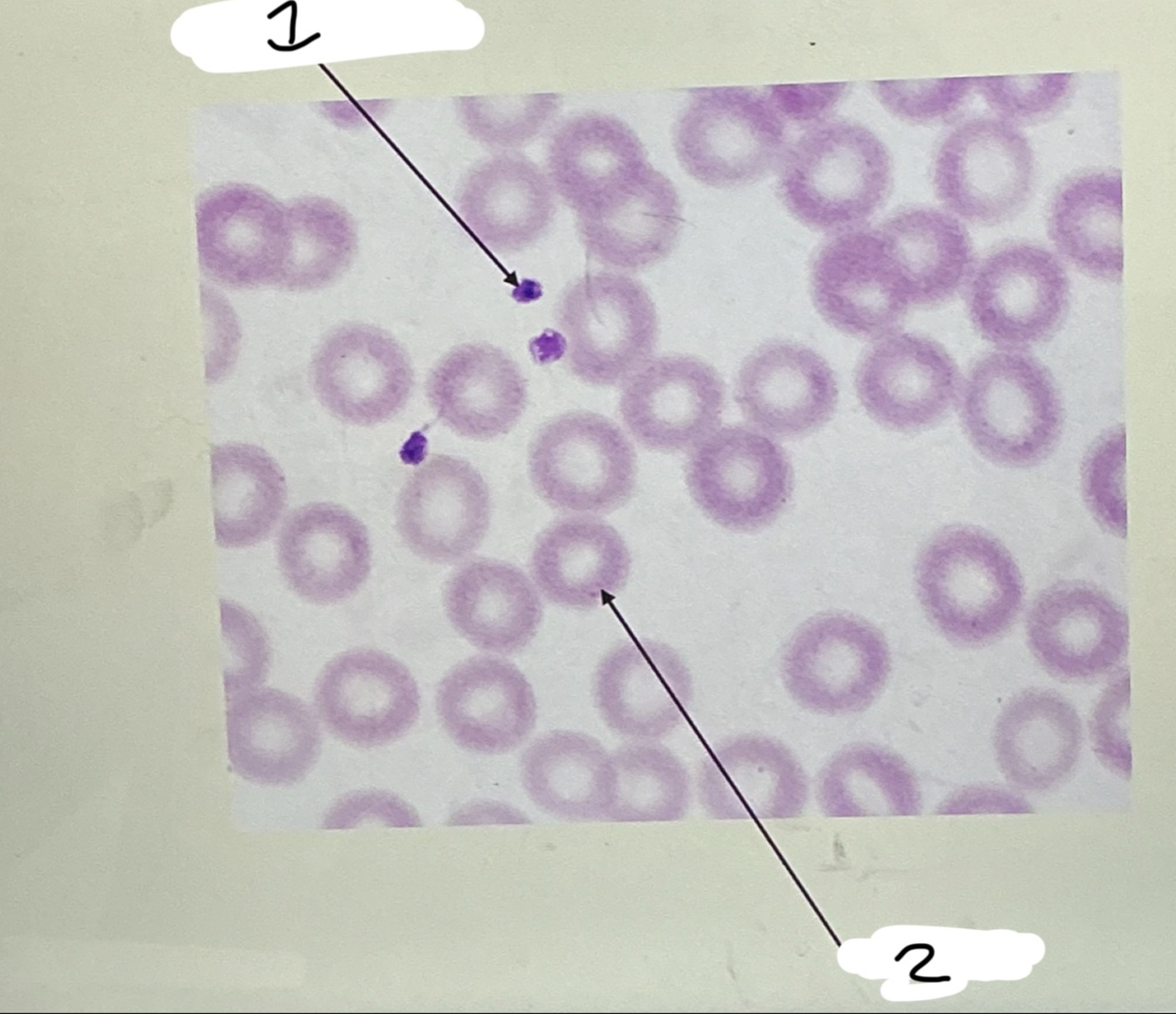 <p>RBCs</p><p>■ Most common XX XX</p><p>■ Do not have a XX</p><p>■ Carry oxygen via XX</p><p>1:XX</p><p>2.XX</p>