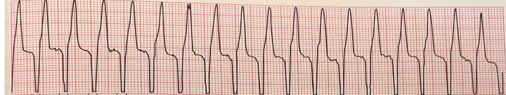 <p><span>The ________ arrhythmia is fast and characterized by bizarre looking QRS complexes with no P or T wave. This arrhythmia can be treated with Lidocaine or beta blockers if the arrhythmia is stable. Please name the arrhythmia shown below.</span></p>