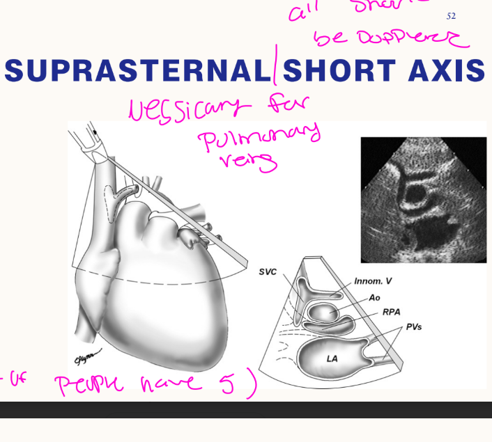 <p>What is the first branch of the aortic arch seen in suprasternal SAX?<br>→ Right innominate artery</p><p>What does the right innominate artery bifurcate into?<br>→ Right subclavian and right common carotid arteries</p><p>What is the second branch of the aortic arch?<br>→ Left common carotid artery</p>