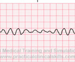<p><span>ventricular fibrillation</span><br><span>tx: cardiac emergency- No CO- start CPR, defibrillate (is NOT synchronized), antiarrythmic drugs within 2 mins. epinephrine every 3 mins, then amiodarone if failed</span></p>