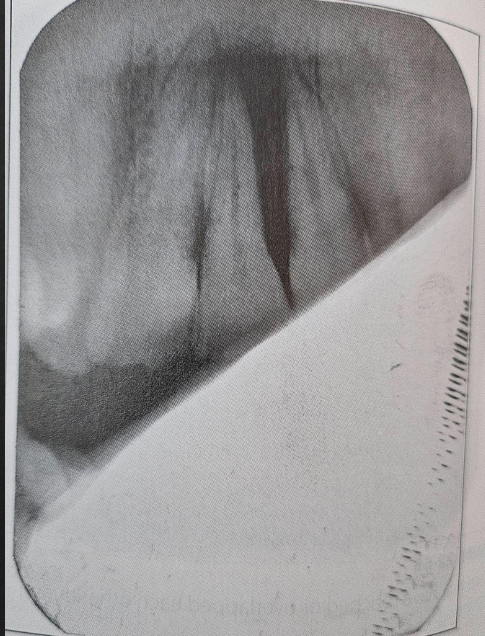<p>What is a partial image caused by?</p>