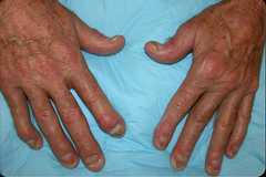 <p>a condition in which the joints become inflamed, causing pain and stiffness, making it hard for people to grip or move</p>