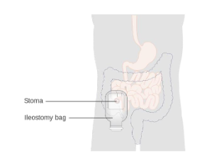 <ul><li><p><span>Opening of small intestines (ileum)</span></p></li><li><p><span>Located RIF (right iliac fossa)</span></p></li><li><p><span>Watery content (drainage 3-6 times a day)</span></p></li><li><p><span>Protrudes 50mm (spout to drain faeces) - bag contents are brown</span></p></li><li><p><span>End-ileostomy (temporary or permanent)</span></p></li><li><p><span>Loop ileostomy</span></p></li></ul><p></p>
