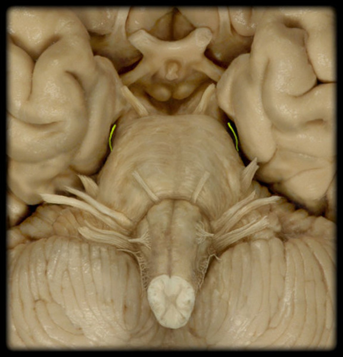 <p>Name:</p><p>Trochlear</p><p>Sensory or Motor:</p><p>Motor</p><p>Key Functions:</p><p>Down &amp; in (superior oblique)</p><p>Symptoms:</p><p>Vertical diplopia</p><p>Clinical:</p><p>Head tilt away, stairs difficulty</p>