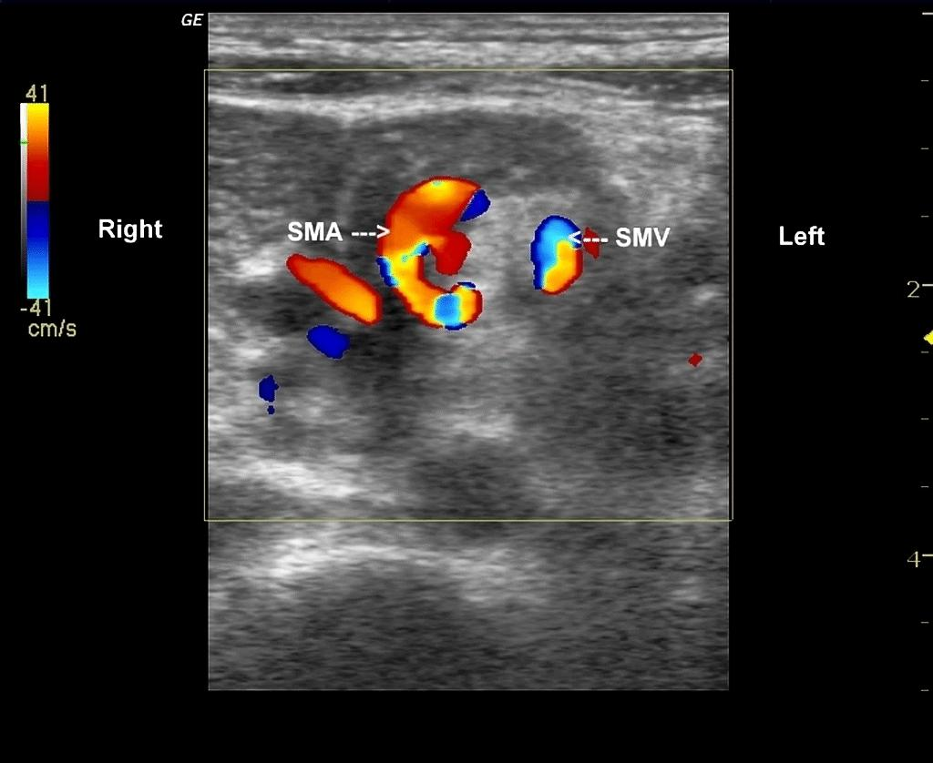 <p>volvulus</p>