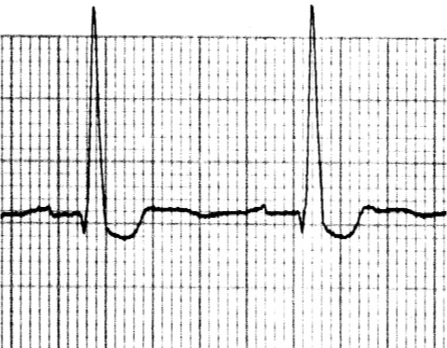 <ul><li><p>Bradycardia </p></li><li><p>AV block </p></li><li><p>Frequent PVCs </p></li><li><p>Multifocal V-tach </p></li><li><p>Junctional escape </p></li><li><p>Yellow green halos </p></li><li><p>Dizziness and weakness </p></li><li><p>Flu-like symptoms </p></li><li><p>Toxic hyperkalemia </p></li></ul><p></p>