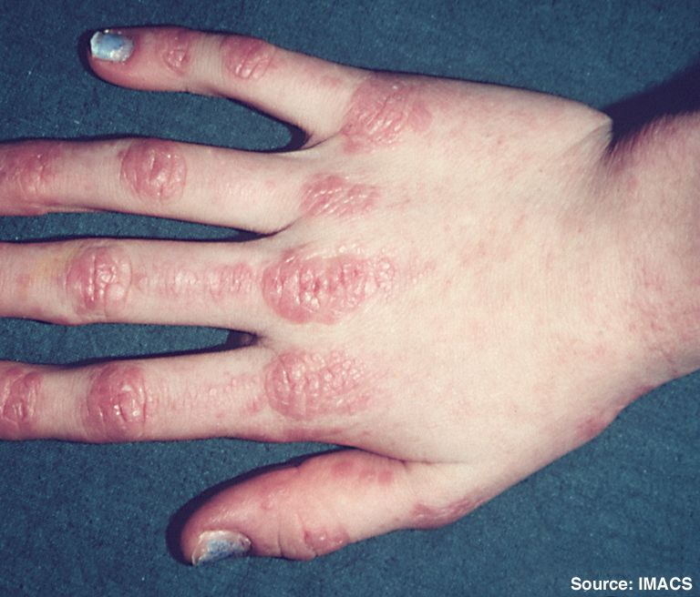 <p>What skin presentation caused by dermatomyositis is shown here?</p>