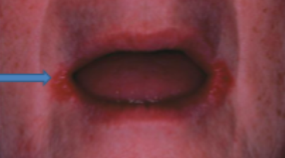 <p>what is this condition</p>