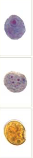 <p>cyst form has 4 nuclei and lacks peripheral chromatin<br>troph form has blot like karyosome with granular or vacuolated cytoplasm</p>