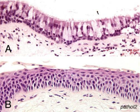 <p>What pathologic change has occurred for A to change to B </p>