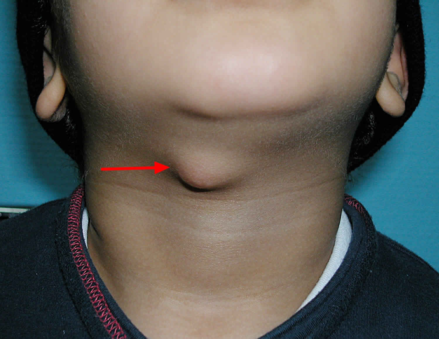 <p>thyroglossal duct cyst or enlarged thyroid, when does it move?</p>
