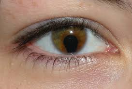 <p>defecto en iris/ retina ya que no se cierra la fisura coroidea</p>