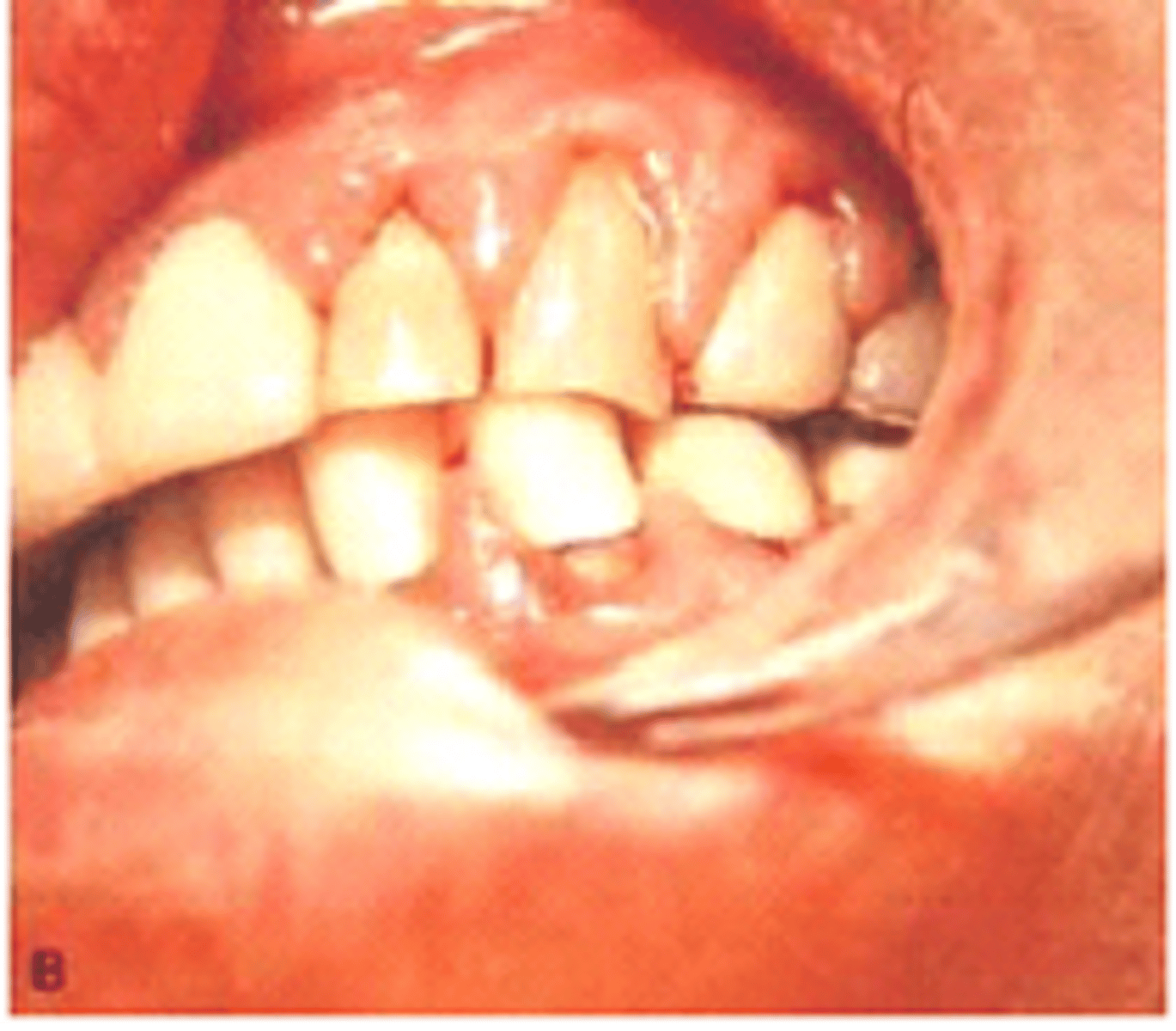 <p><span>Seen by a patient taking nifedipine (Ca Channel blocker)</span></p>