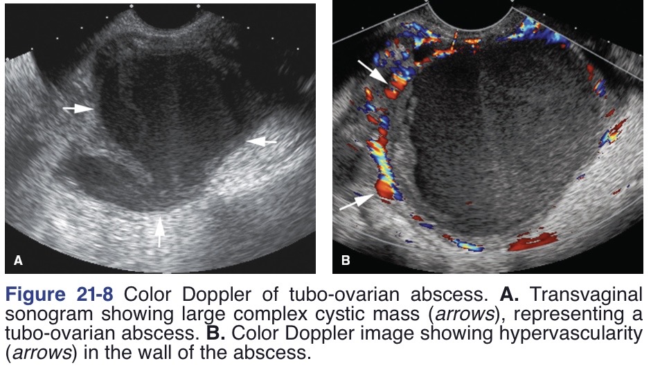 <p>Thickened, irregular endometrium</p><p>Pyosalpinx or hydrosalpinx</p><p>Cul-de-sac fluid</p><p>Multicystic and solid complex adnexal mass(es)</p><p>Complete loss of borders of all adnexal structures and the development of a conglomerated adnexal (possibly bilateral) mass</p>