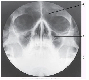 <p>which paranasal sinuses are labeled with the letter A in this image</p>