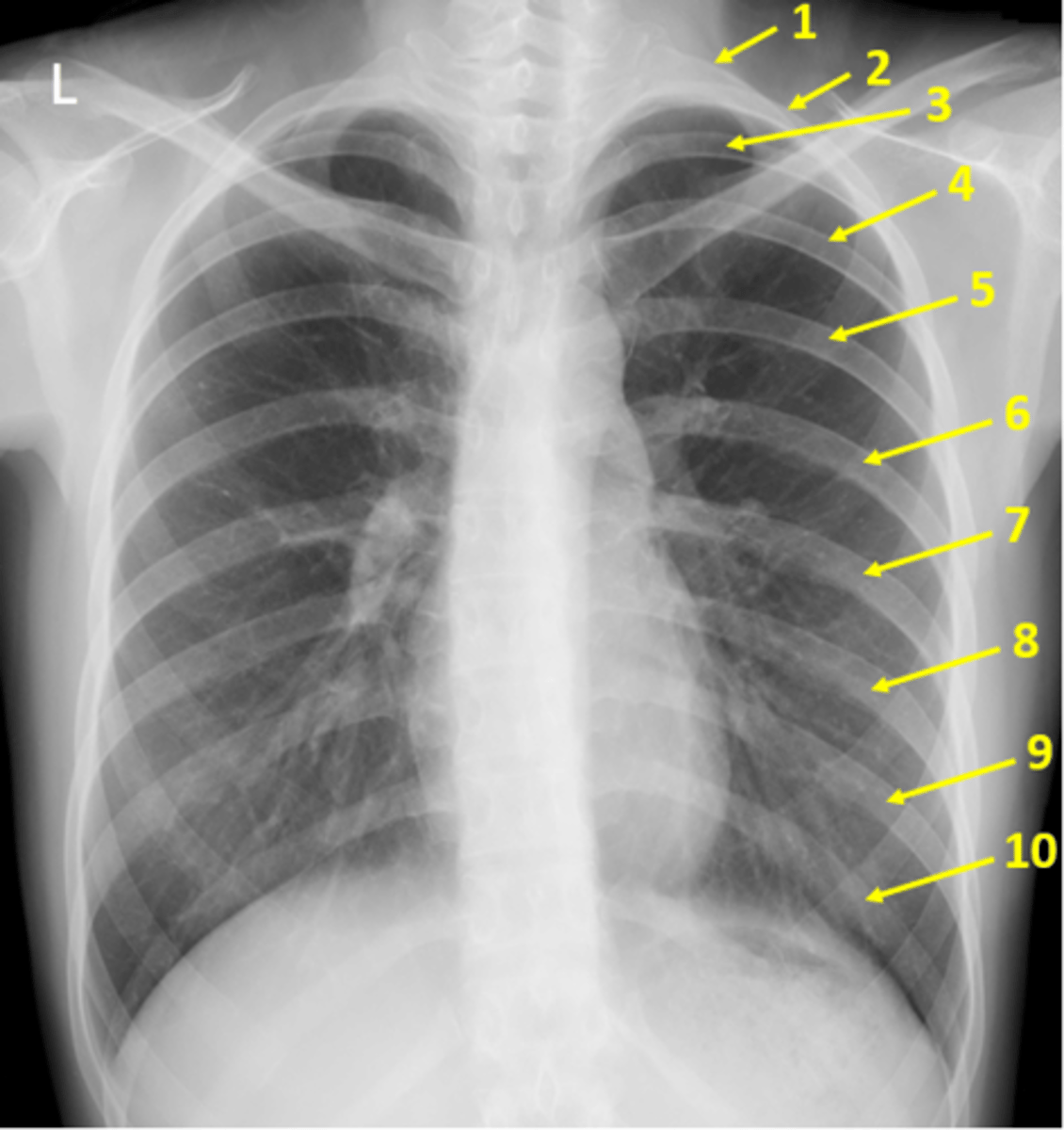 <p>You can count at least 10 posterior ribs</p>