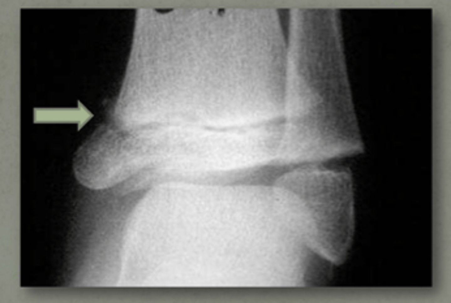 <p>crush injury</p>