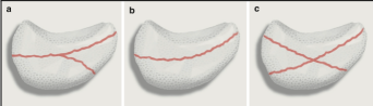<p>Just like the scaphoid bone, the _______ is also at risk for</p><p>avascular necrosis called<strong> Kienbock’s Disease.</strong></p><p>○ Rare condition where the _______ loses blood supply,</p><p>resulting in bone death.</p><p>○ Presents as a complication of the fracture</p>