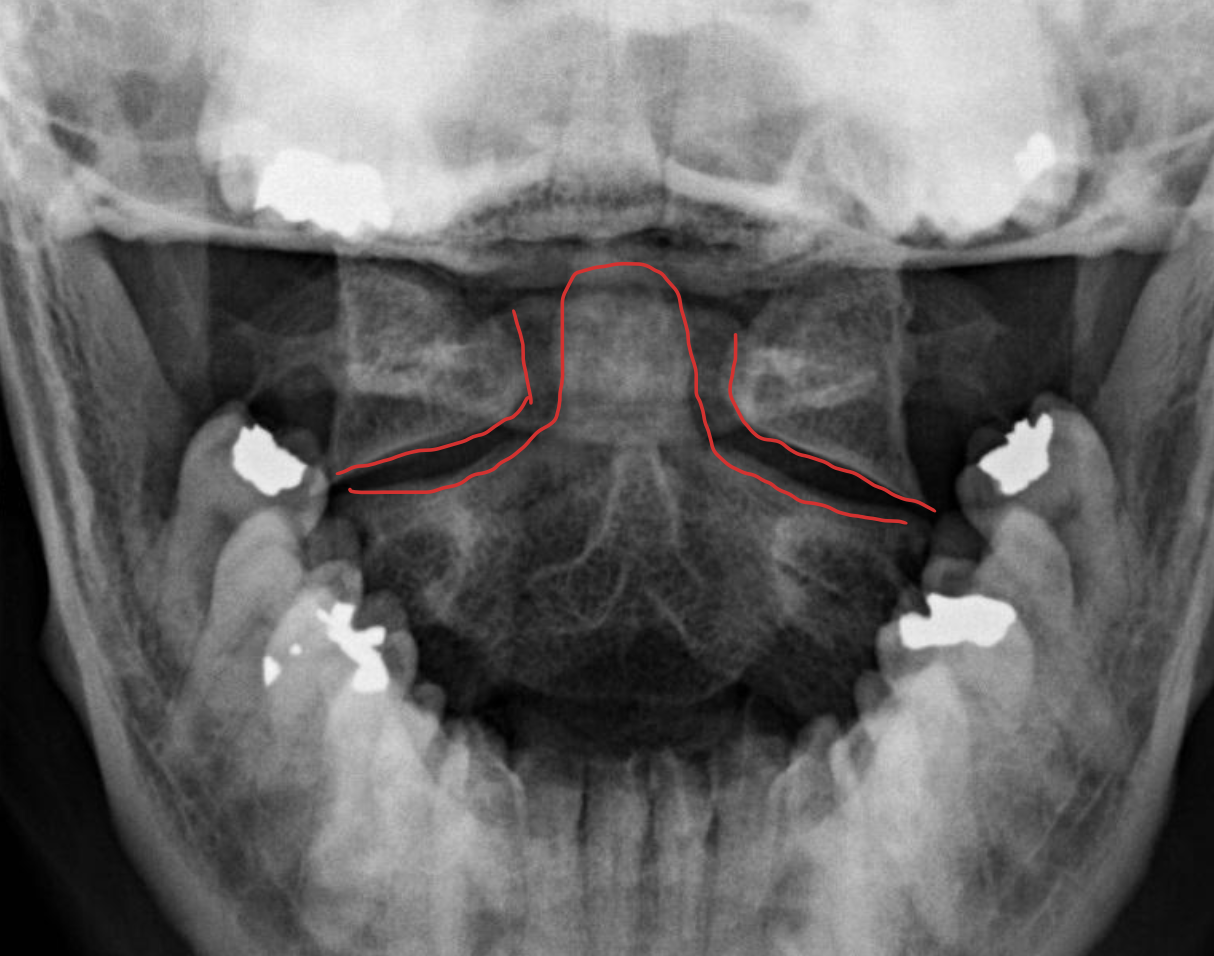 <p><span>寰枢关节</span></p>