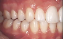 <p>anterior, second premolar</p>