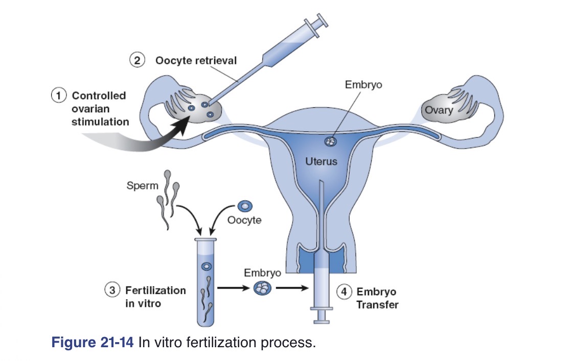 <p>Fertility treatment that requires a mature ovum to be extracted from the ovary, with fertilization taking place outside the body (4-8 embryos are placed into uterus)</p>