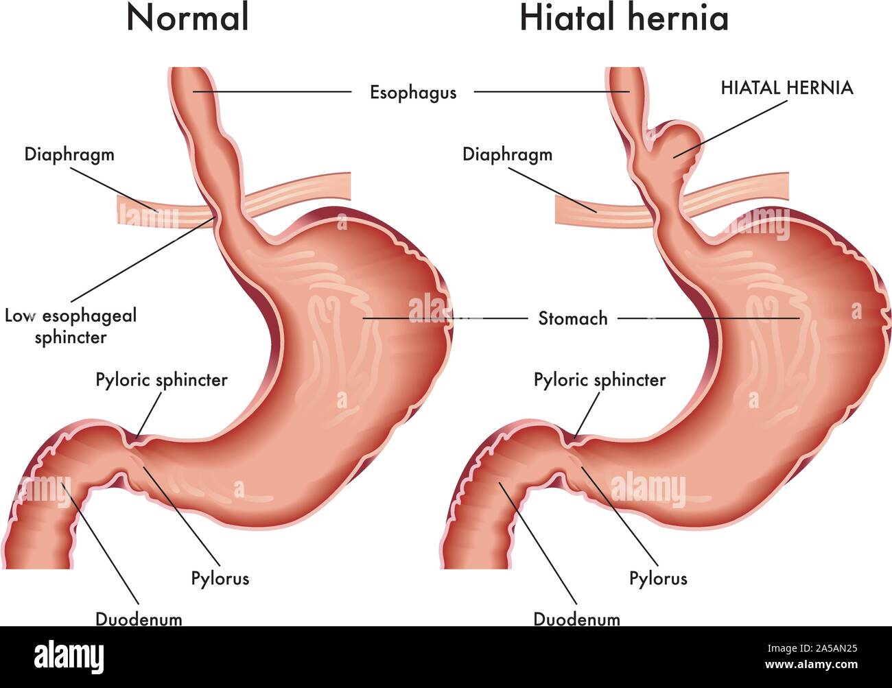 <p>Pyloric sphincter</p>