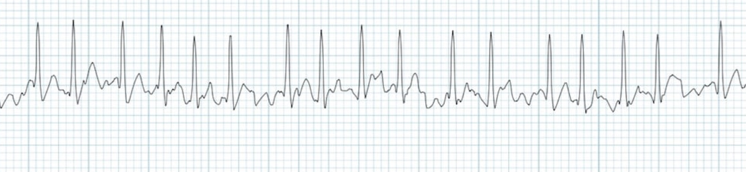 <p>What rhythm/abnormality is seen below?</p>