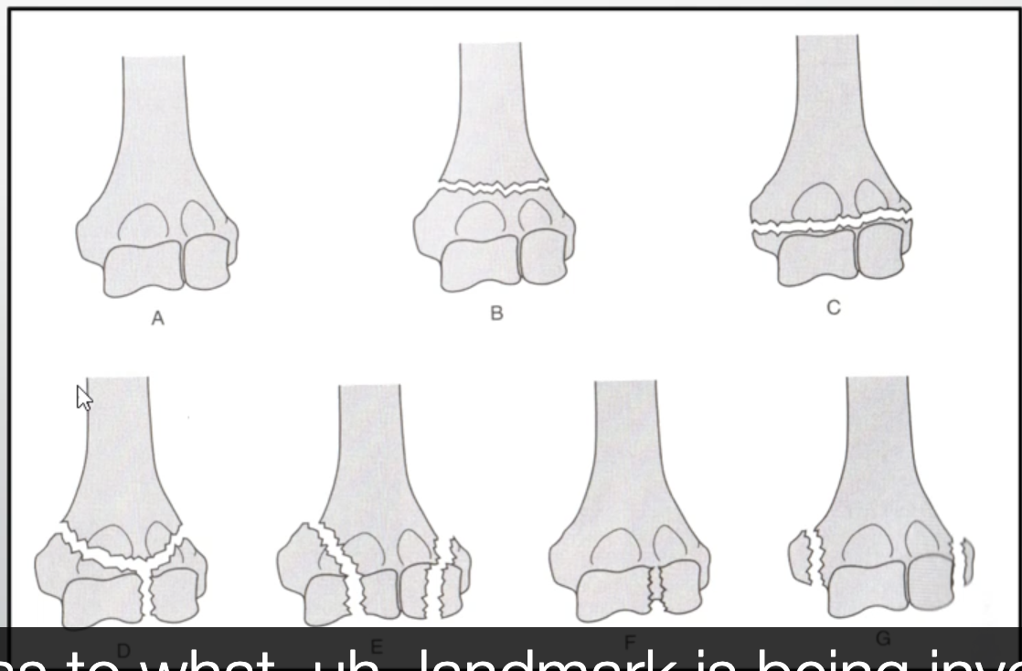 <p>distal humerus fractures</p>