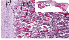<p>What feature of new bone is indicated by the arrows labeled 'B' in this slide of canine claw?</p>
