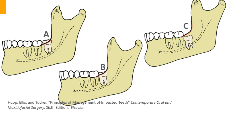<p>-relates depth of impaction to second molar</p>