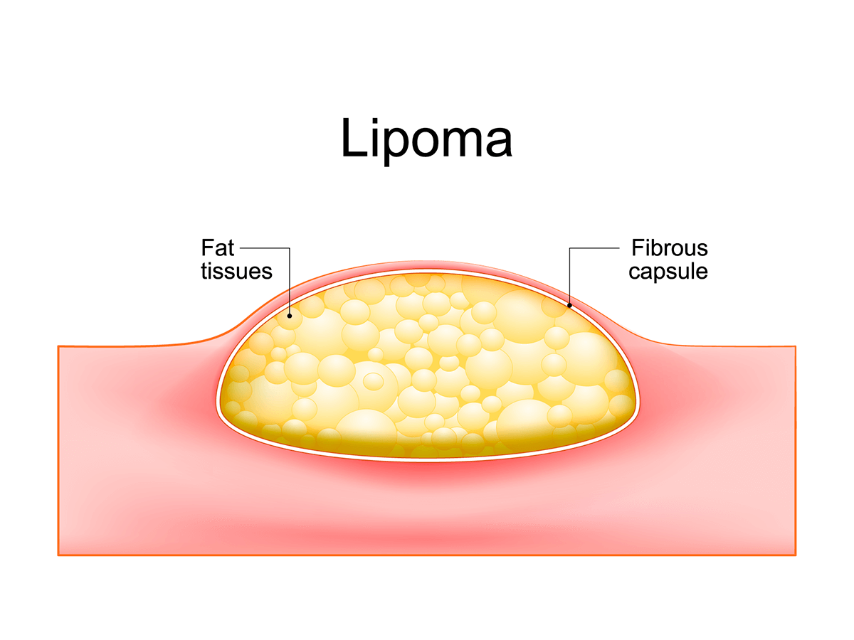 <p>A benign tumor made of fat cells.</p>