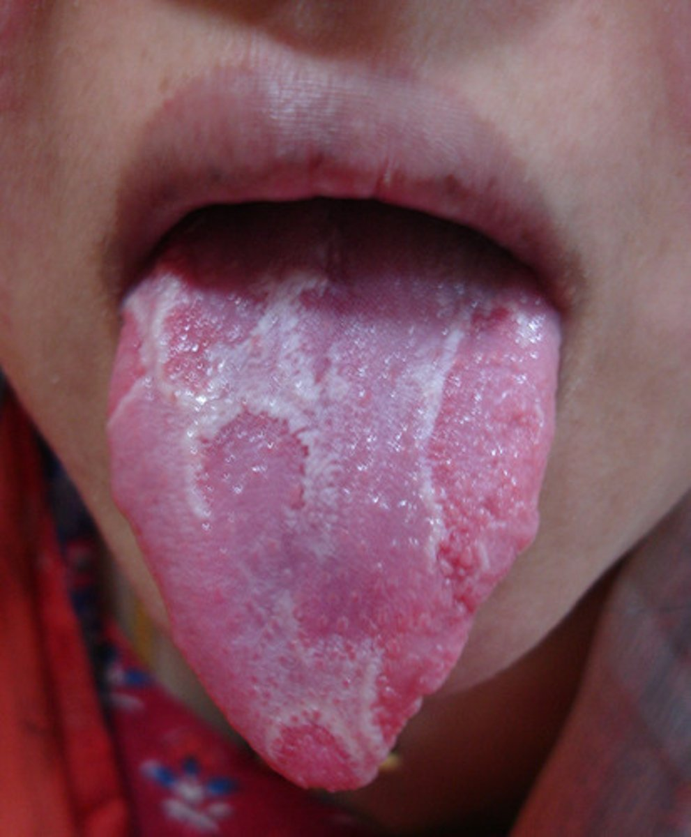 <p><br><span>the lesions by the arrows on the dorsal of the tongue are characterized by diffuse areas devoid of filiform papillae that form on the dorsal and lateral borders of the tongue are called</span></p>
