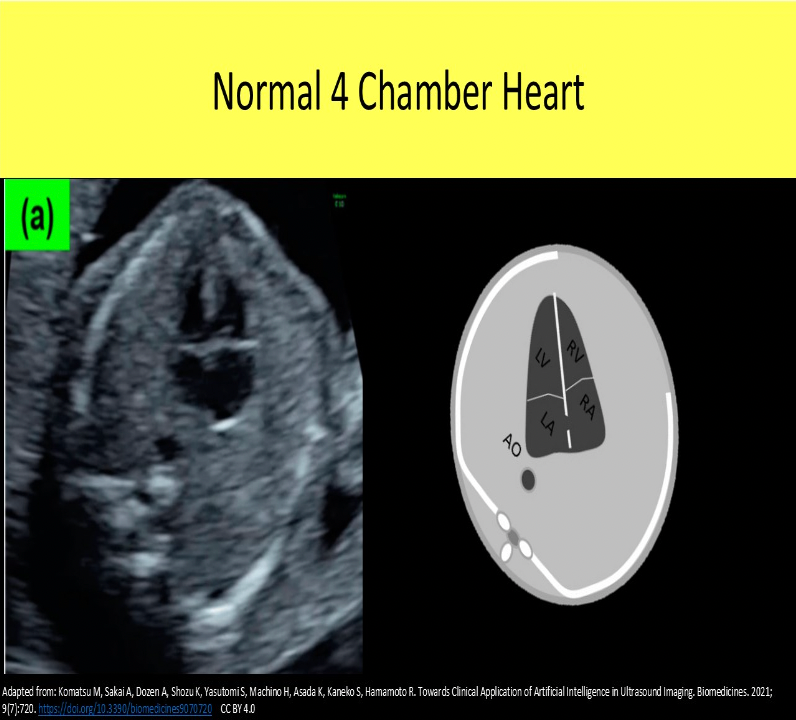 <p>B. left atrium</p><p>The left atrium is the most posterior cardiac chamber and the right ventricle is the most anterior cardiac chamber in the normal heart.</p>