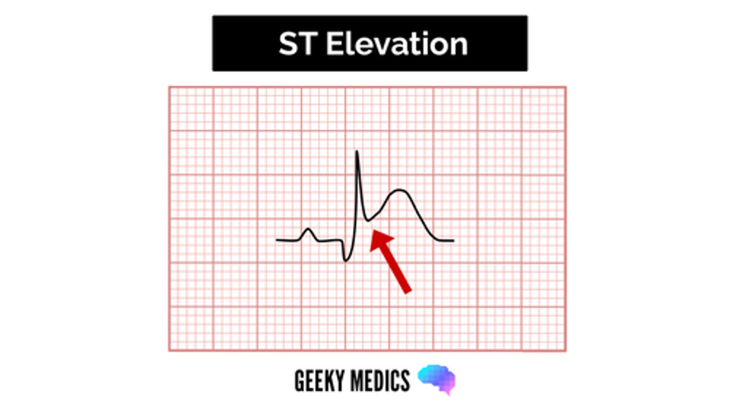 <p>C) Elevated ST segment on EKG and indicates an ongoing heart attack requiring immediate intervention</p>
