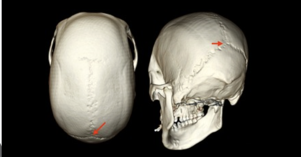 <p>where the sagittal suture and lambdoid suture meet</p>