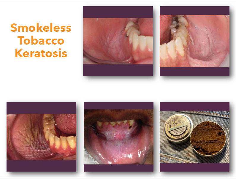 <p>smokeless tobacco keratosis clinical features </p>