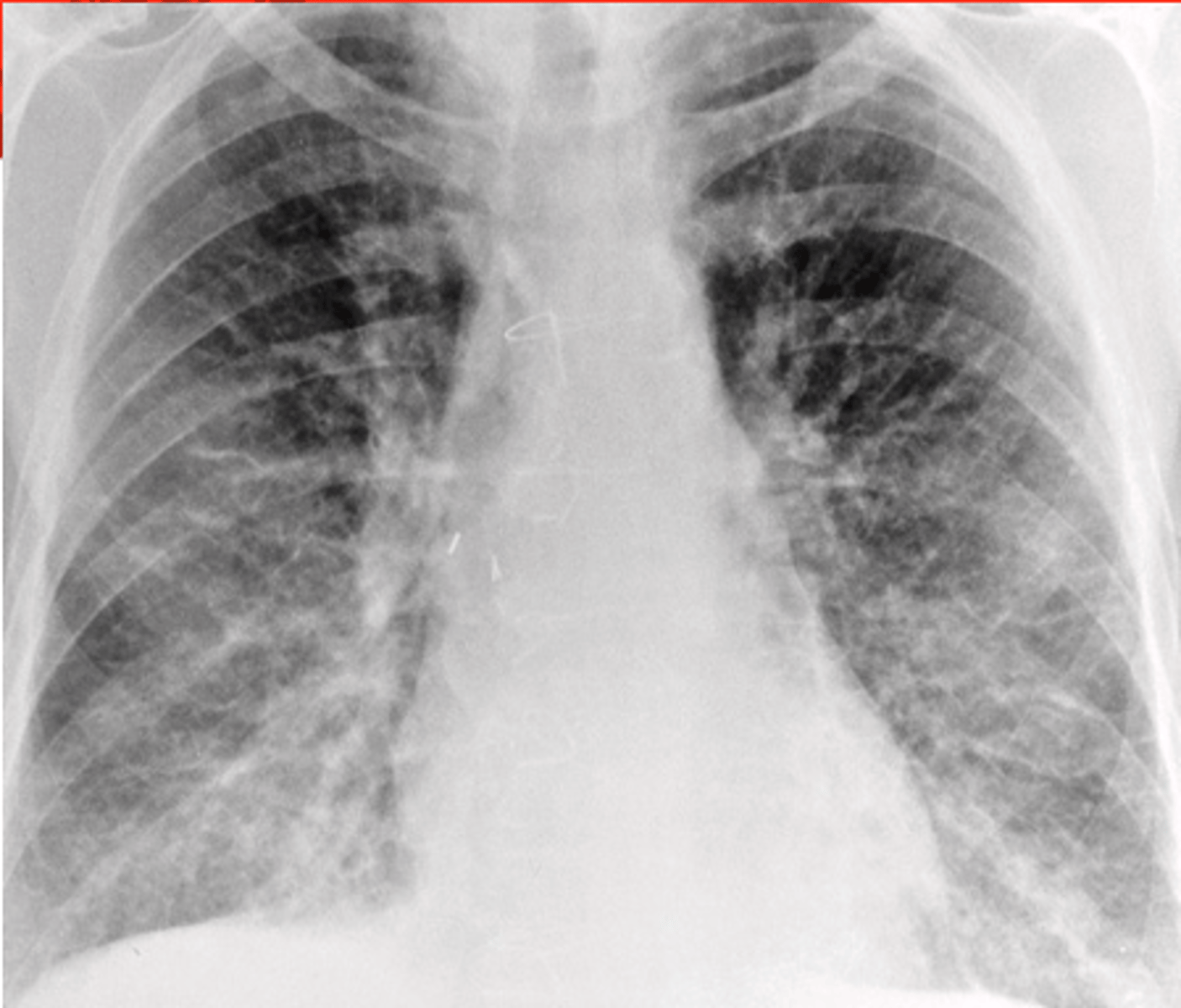 <p>A. Pulmonary edema</p>