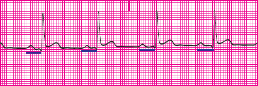 <p>Which rhythm is this?</p>