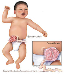 <p>At six to ten weeks of embryonic development, a fetus's intestines will herniate into the umbilical cord. The fetus's abdomen will grow, and then the intestines will return to the abdomen at ten or eleven weeks. Gastroschisis occurs when the intestines do not return and instead remain outside of the abdomen. Unlike in omphalocele, the intestinal contents are uncovered in gastroschisis.</p>