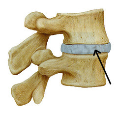<p>A functional joint classification describing a joint with limited movement.</p>