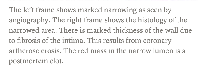 <p>placa de ateroma </p>