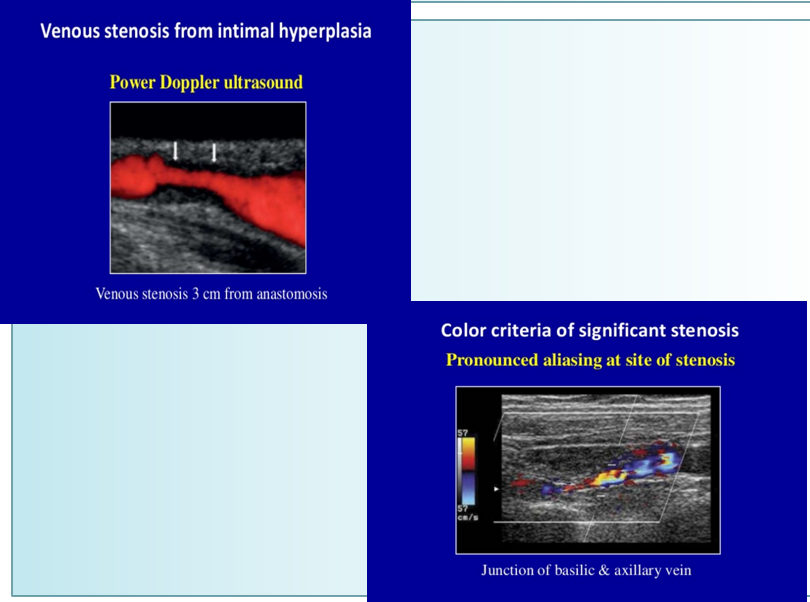 <p>stenosis at venous anastomosis </p><ul><li><p>arterial anastomosis is uncommon</p></li></ul><p></p>