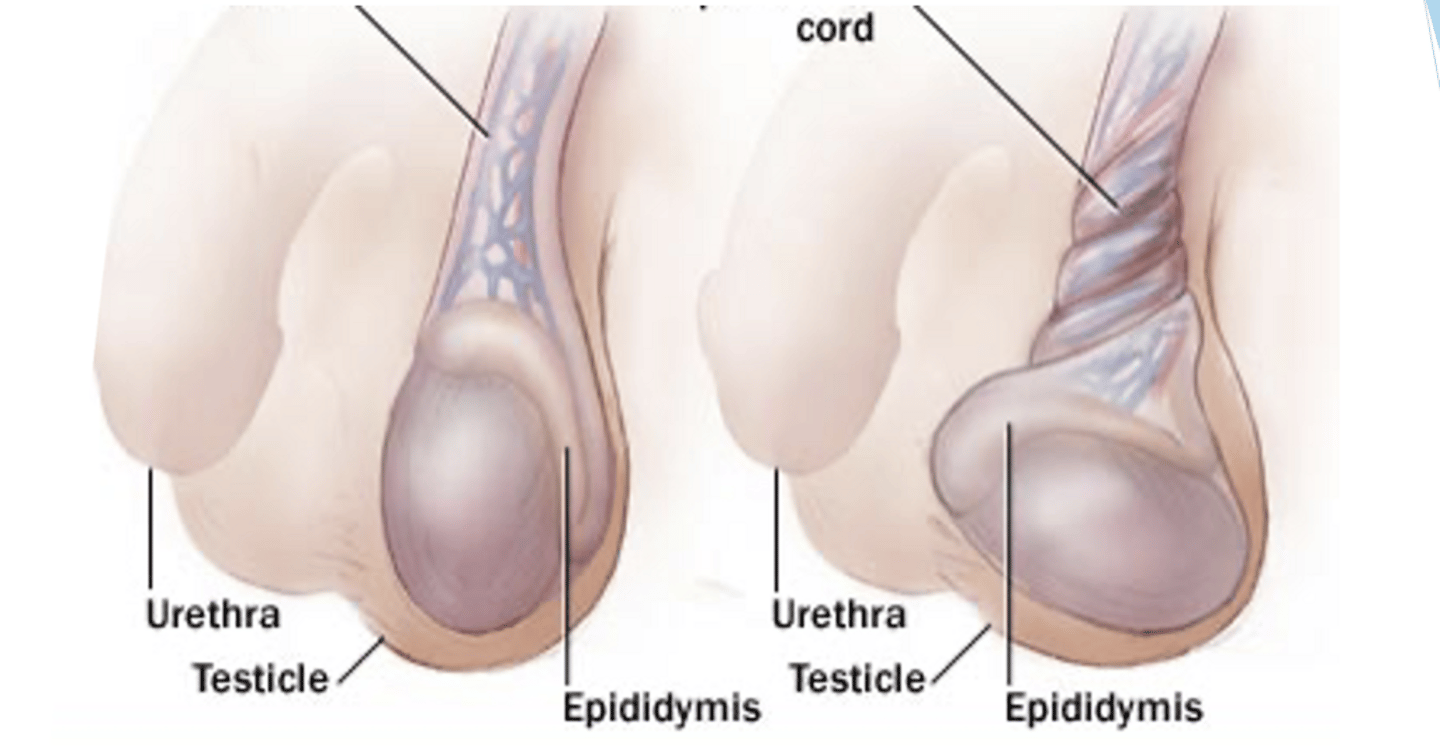 <p>cryptorchidism and "bell clapper" deformity</p>